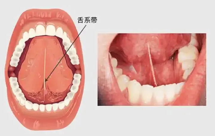舌头有个重要的结构就是舌系带,俗称 舌筋(非蛇精哈哈)