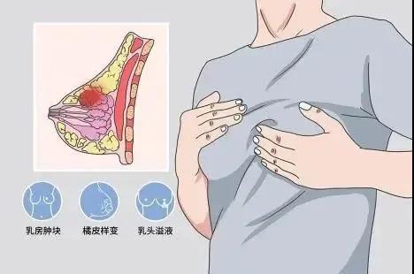 单侧乳房少量血性溢液图片